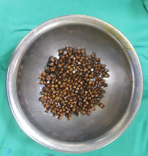 Bác sĩ BV E hoảng hốt nhặt bát sỏi gần 400 viên trong mật người phụ nữ-1