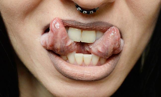 Trào lưu tách lưỡi của giới trẻ với những biến chứng khủng khiếp-2