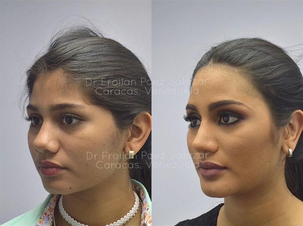 Giật mình với nhan sắc đập đi xây lại của những hoa hậu Venezuela nổi tiếng nhất thế giới-4