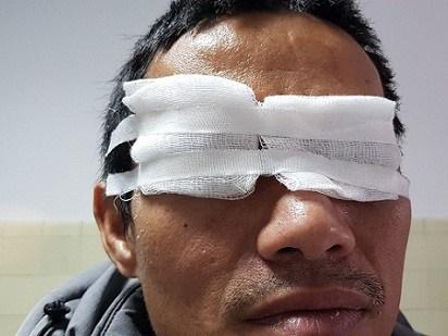 Cận cảnh hình ảnh bác sĩ rút đinh dài đâm ngập mắt bệnh nhân-3