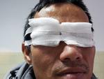 Quảng Bình: Một nam giới đối mặt với nguy cơ mù mắt phải vì 'chơi' pháo hoa dịp lễ tết