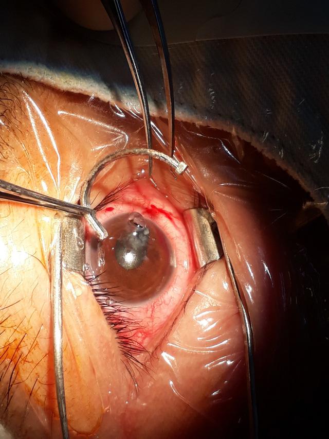 Cận cảnh hình ảnh bác sĩ rút đinh dài đâm ngập mắt bệnh nhân-1