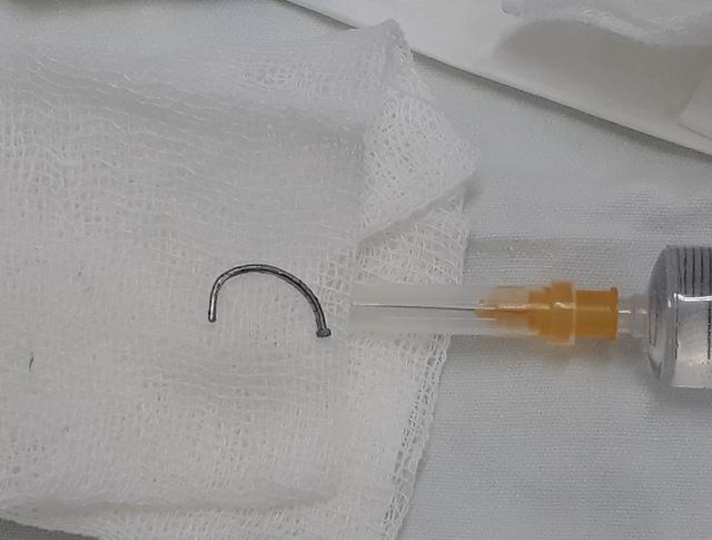 Cận cảnh hình ảnh bác sĩ rút đinh dài đâm ngập mắt bệnh nhân-2