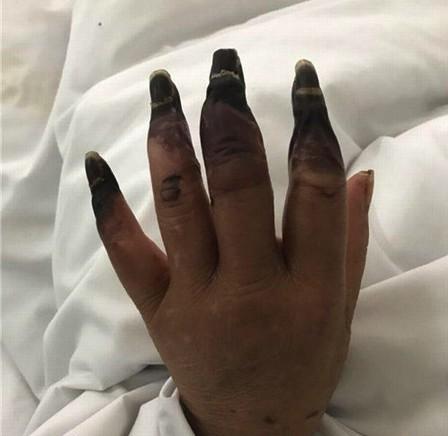 Hậu quả kinh hoàng từ một vết đứt tay trong khi làm việc nhà-2