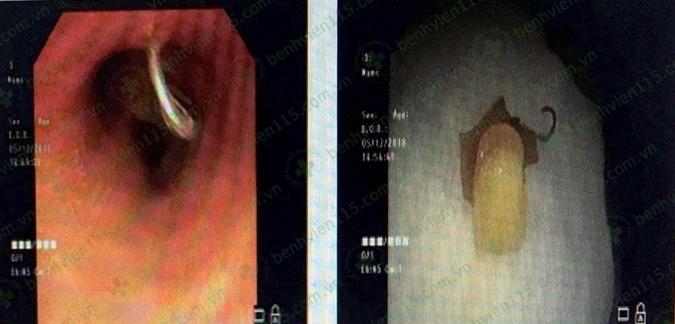 Sau cơn ho, người đàn ông rơi răng giả vào khí quản-1