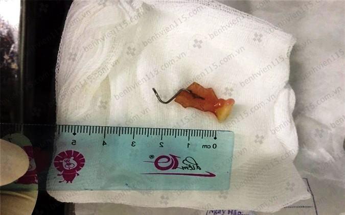 Sau cơn ho, người đàn ông rơi răng giả vào khí quản-2