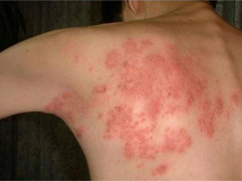 Hoảng hồn gương mặt lốm đốm nốt trắng, nốt đen vì đắp lá trầu làm đẹp-3