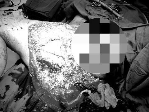 Cô gái bị kéo lê trên đường sau tai nạn được cứu sống nhờ truyền 7 lít máu