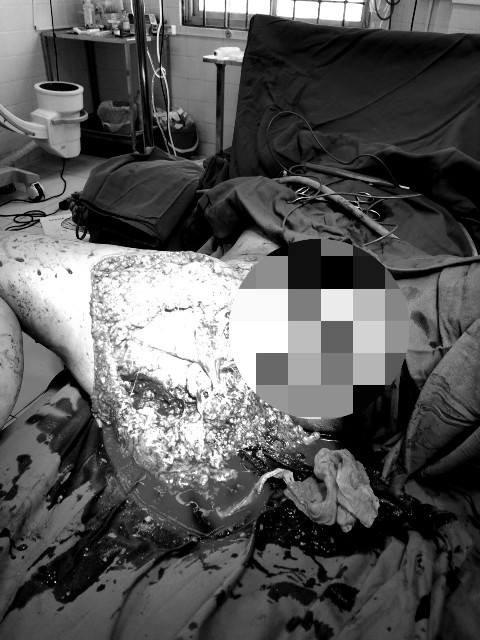 Cô gái bị kéo lê trên đường sau tai nạn được cứu sống nhờ truyền 7 lít máu-1