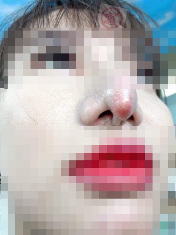 Gặp thẩm mỹ viện không có tâm, cô gái xinh đẹp dở khóc dở cười khi bị trả lại chiếc mũi khoằm phù thủy nhìn thấy gớm-1