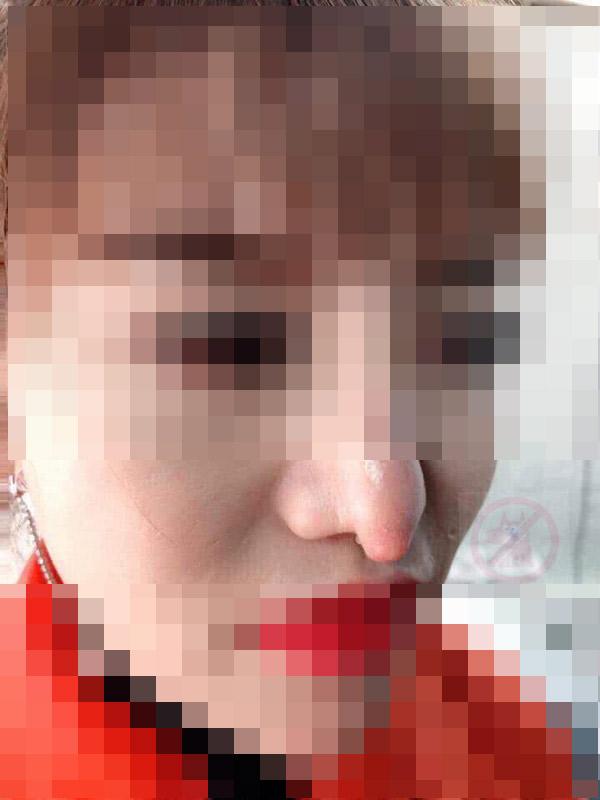 Gặp thẩm mỹ viện không có tâm, cô gái xinh đẹp dở khóc dở cười khi bị trả lại chiếc mũi khoằm phù thủy nhìn thấy gớm-2