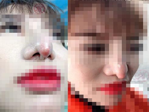 Gặp thẩm mỹ viện không có tâm, cô gái xinh đẹp dở khóc dở cười khi bị 'trả lại' chiếc mũi khoằm phù thủy nhìn thấy gớm