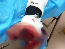 Vừa sạc vừa dùng điện thoại, thiếu niên 17 tuổi bị nát bàn tay Vừa sạc vừa dùng điện thoại, thiếu niên 17 tuổi bị nát bàn tay
