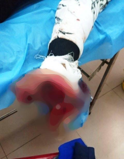 Vừa sạc vừa dùng điện thoại, thiếu niên 17 tuổi bị nát bàn tay-1