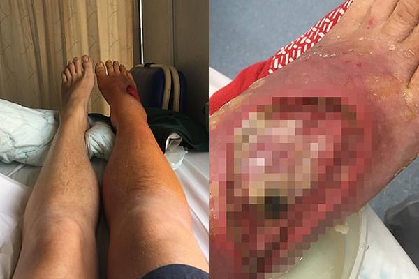 Rùng mình, bác sĩ thả 400 con giòi vào chân để ăn thịt chữa bệnh-1