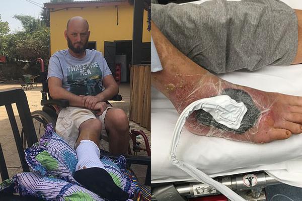 Rùng mình, bác sĩ thả 400 con giòi vào chân để ăn thịt chữa bệnh-2