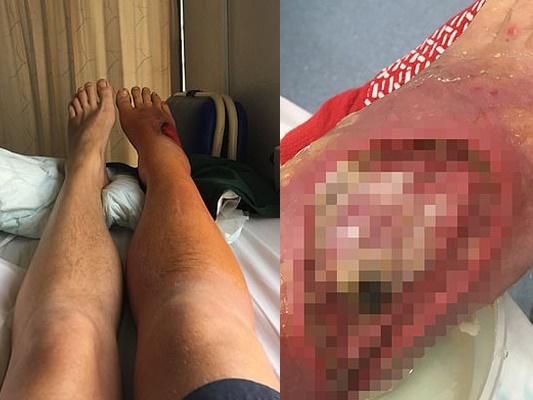 Tìm thấy giòi sống trong u trên trán một người phụ nữ-3