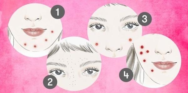 Bí kíp xử đẹp 4 loại mụn đáng ghét một cách thần tốc ai cũng làm được-1