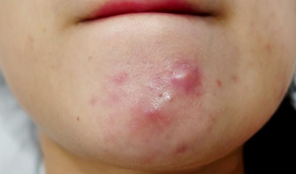 Bí kíp xử đẹp 4 loại mụn đáng ghét một cách thần tốc ai cũng làm được-2