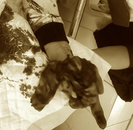 Rùng mình nhìn bàn tay thiếu niên dập nát do nghịch thuốc pháo-1