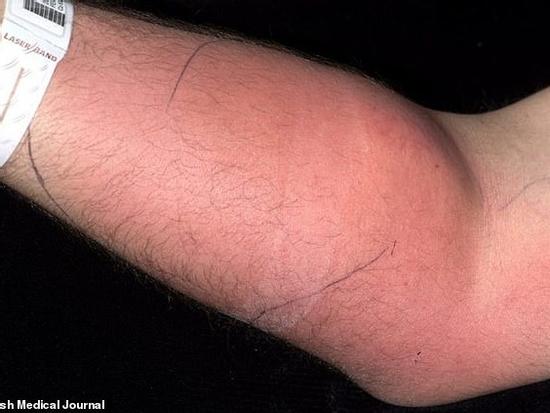 Tự tiêm tinh trùng vào tay người đàn ông 33 tuổi nhập viện gấp