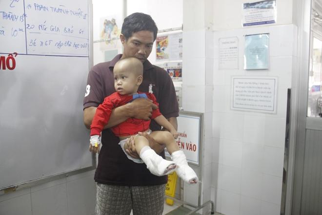 Bố hút thuốc bén lửa vào bình gas, con gái 10 tuổi bỏng nặng-1