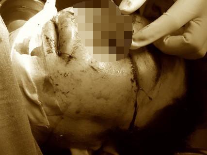 Thương tâm: Chuẩn bị ăn cơm thì nổ bình gas, cả gia đình 4 người bỏng nặng-4