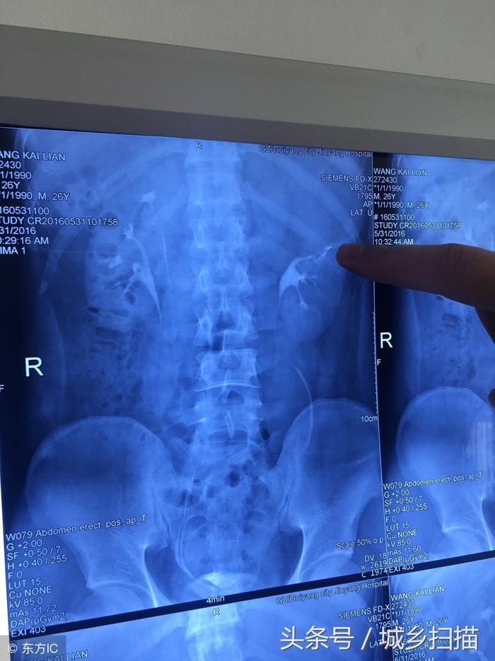 Nam thanh niên uống rượu thay nước lọc, đi khám phát hiện có 4 quả thận-2