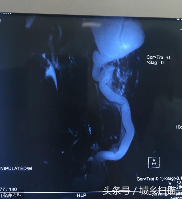 Nam thanh niên uống rượu thay nước lọc, đi khám phát hiện có 4 quả thận-3