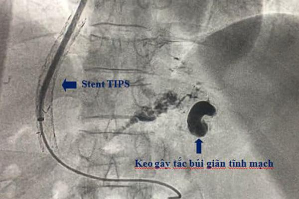 Quý ông nôn ra cả vũng máu vì loại đồ uống triệu người mê mẩn-1