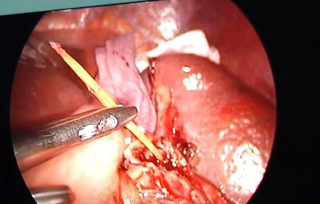 Người đàn ông bị thủng lá lách vì ngậm tăm đi ngủ-1