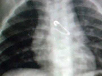 Người đàn ông bị thủng lá lách vì ngậm tăm đi ngủ-3