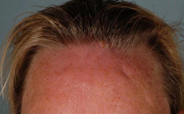 Tìm thấy giòi sống trong u trên trán một người phụ nữ-2