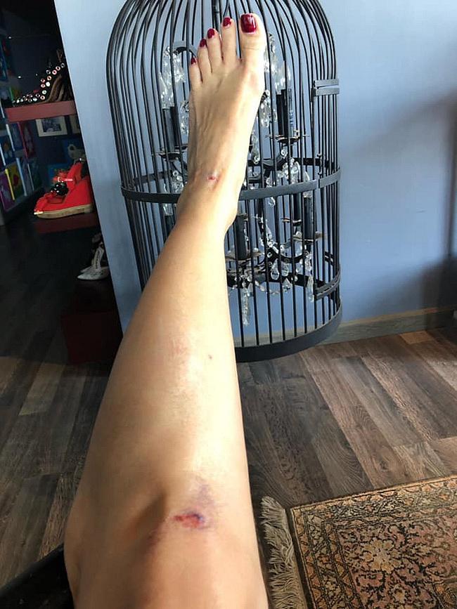 Ca sĩ Hồng Nhung bị ngã xe mồng 3 Tết, thấy còn may mắn vì lý do này-2