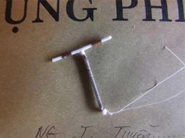 Chiếc vòng thai 31 năm đi lạc vào bàng quang người phụ nữ-2