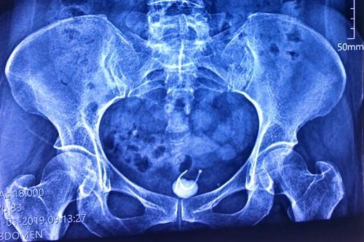 Chiếc vòng thai 31 năm đi lạc vào bàng quang người phụ nữ-1