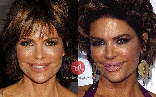 Nữ diễn viên Lisa Rinna từng khổ sở vì đôi môi sưng tấy do thẩm mỹ, sau này cô đã phải rút bớt chất làm đầy ra.