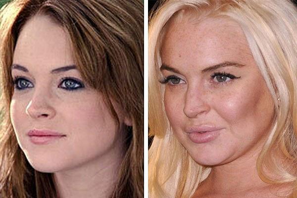 Miệt mài tiêm botox và bơm môi để làm đẹp, nhưng điều trớ trêu là Lindsay Lohan lại… không đẹp hơn trước.