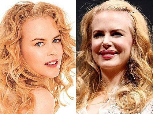 Thiên nga nước Úc Nicole Kidman có phần môi 