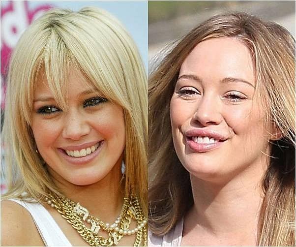 Nhìn ảnh bên phải của Hilary Duff sau khi bơm môi, có lẽ nhiều người sẽ nghĩ cô bị dị ứng vì ăn trúng món gì đó.