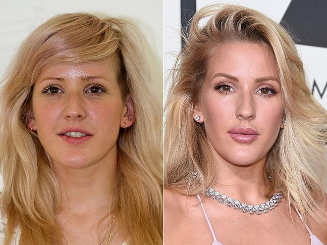 Ellie Goulding bị nhận xét là trở nên đơ cứng vì lạm dụng tiêm filler vào môi