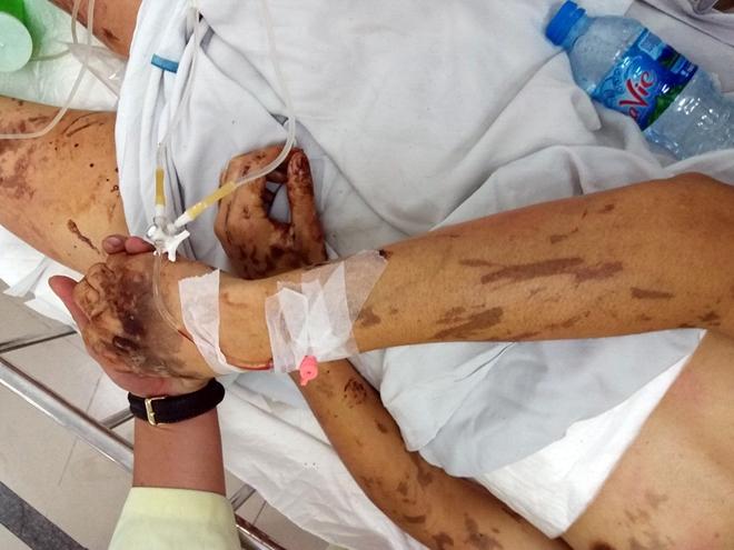 Việt kiều bị tạt axit ngày Tết: Đôi mắt bị tổn thương nặng-4