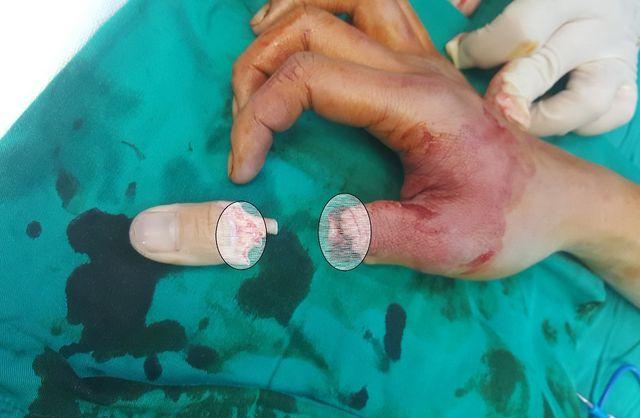 Dây cáp điện thoại rơi xuống cắt lìa ngón tay người đi đường-1