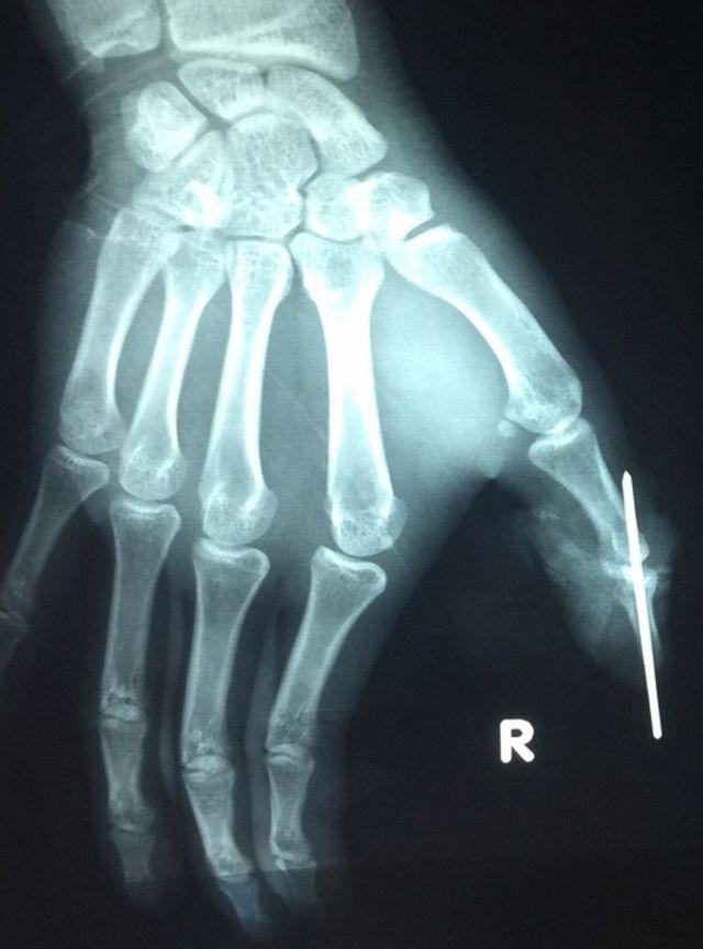 Dây cáp điện thoại rơi xuống cắt lìa ngón tay người đi đường-2