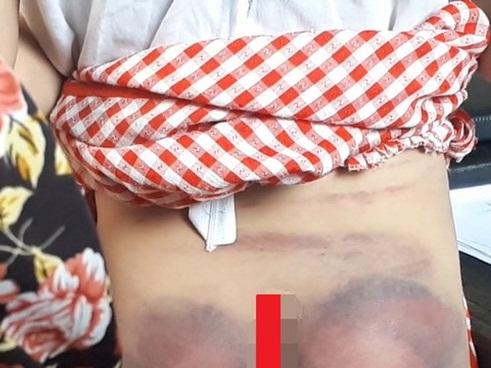 Bé gái 8 tuổi bị cha ruột đánh bầm tím khắp người