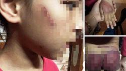 Mẹ rớt nước mắt thấy con gái 8 tuổi bị bố bạo hành thâm tím khắp người