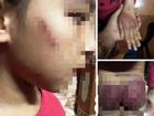 Mẹ rớt nước mắt thấy con gái 8 tuổi bị bố bạo hành thâm tím khắp người