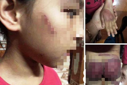 Mẹ rớt nước mắt thấy con gái 8 tuổi bị bố bạo hành thâm tím khắp người-3