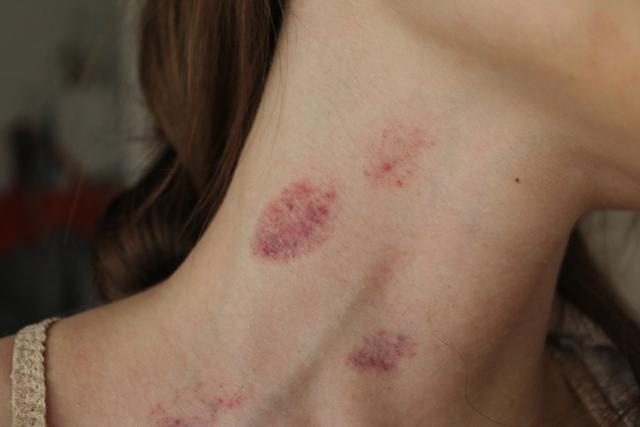 Cô gái 16 tuổi tử vong vì vết hôn cổ của bạn trai-2