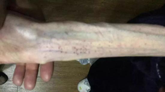 Cánh tay tong teo gây ám ảnh của cô gái trẻ sau 6 tháng giảm cân-1